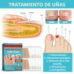 FungiPatch™ – Solución efectiva contra hongos en uñas.